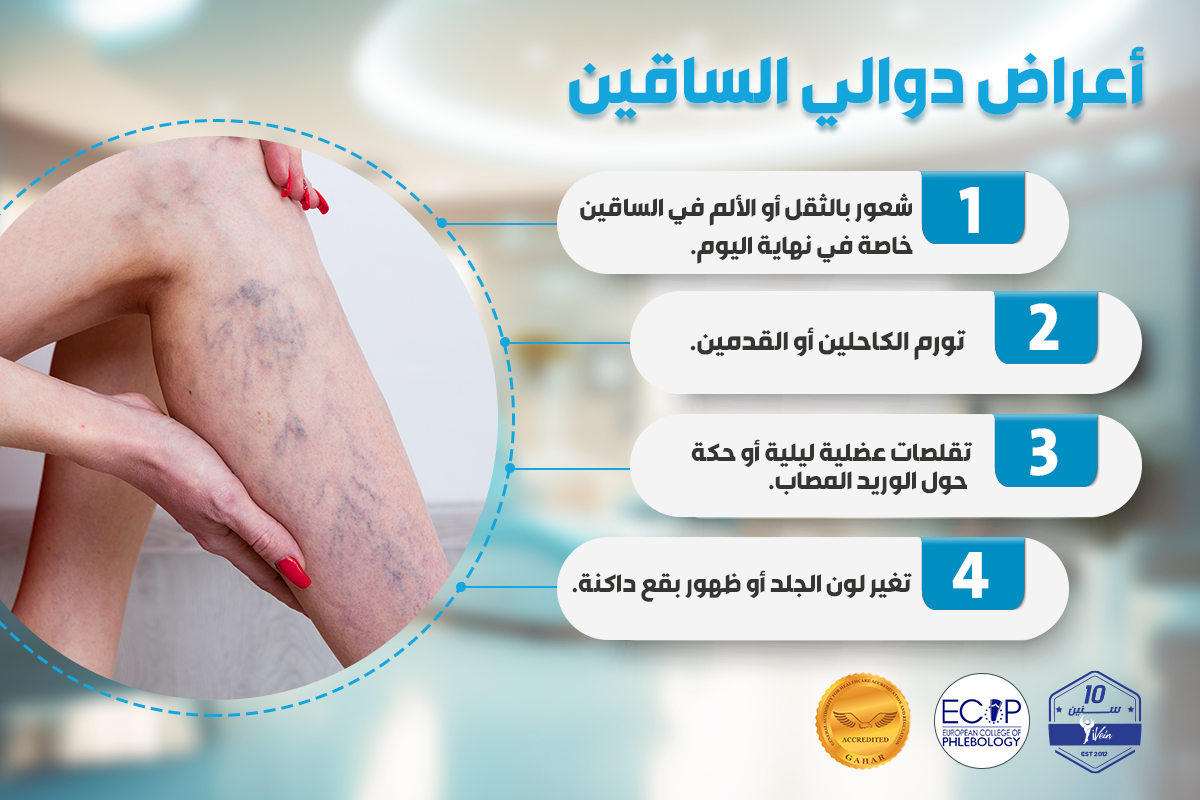 أعراض دوالي الساقين