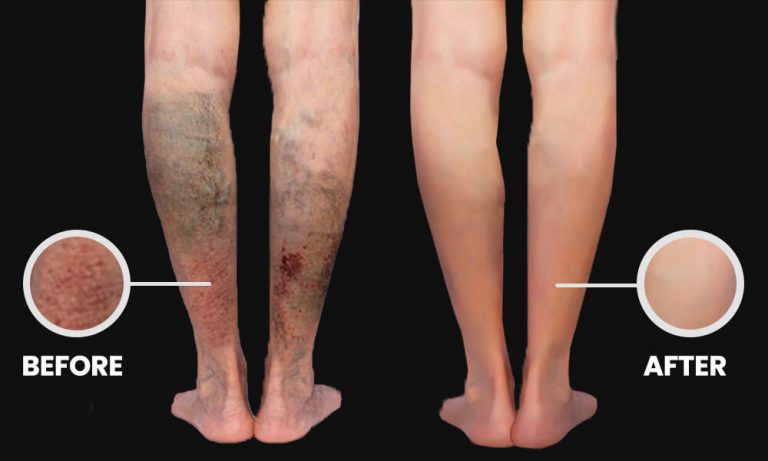 before-after-venous-ulcer