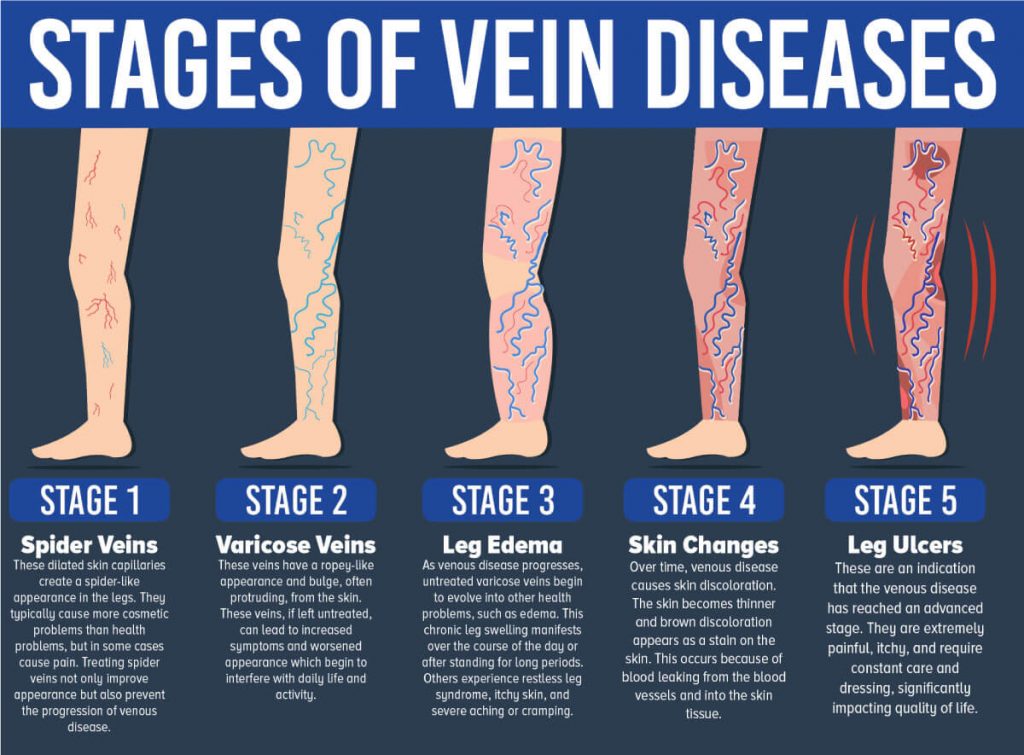 Venous Stasis Ulcer Stages