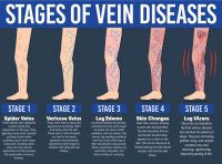 Venous Ulcers - Ivein Clinic