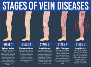 Venous Ulcers - Ivein Clinic