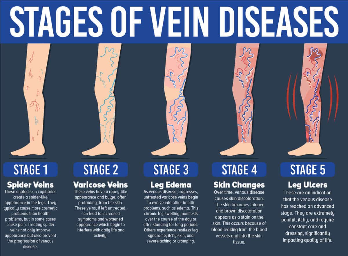 a case study of venous leg ulceration